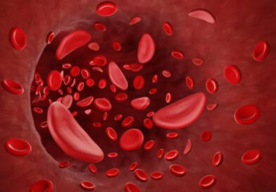 Sickle Cell Anemia is a complex and often misunderstood genetic disorder that affects millions of people worldwide. It is a condition characterized by