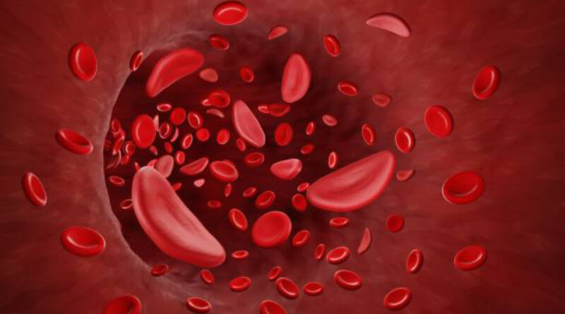Sickle Cell Anemia is a complex and often misunderstood genetic disorder that affects millions of people worldwide. It is a condition characterized by