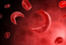 sickle cell anemia in humans